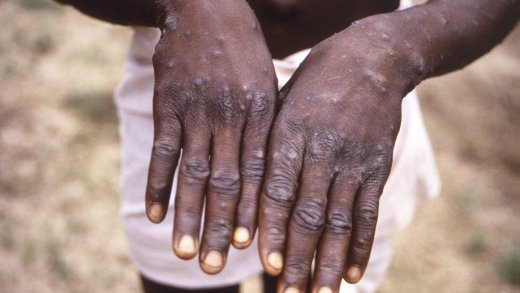 Die US-amerikanischen Gesundheitsbehörde dokumentierte bereist 1997 in Zentral- und Westafrika (Quelle: Keystone)