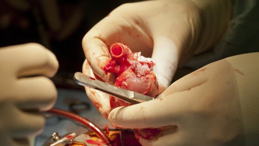 Nach einem Kreislaufstillstand muss es schnell gehen: Herztransplantation. Bild: Keystone
